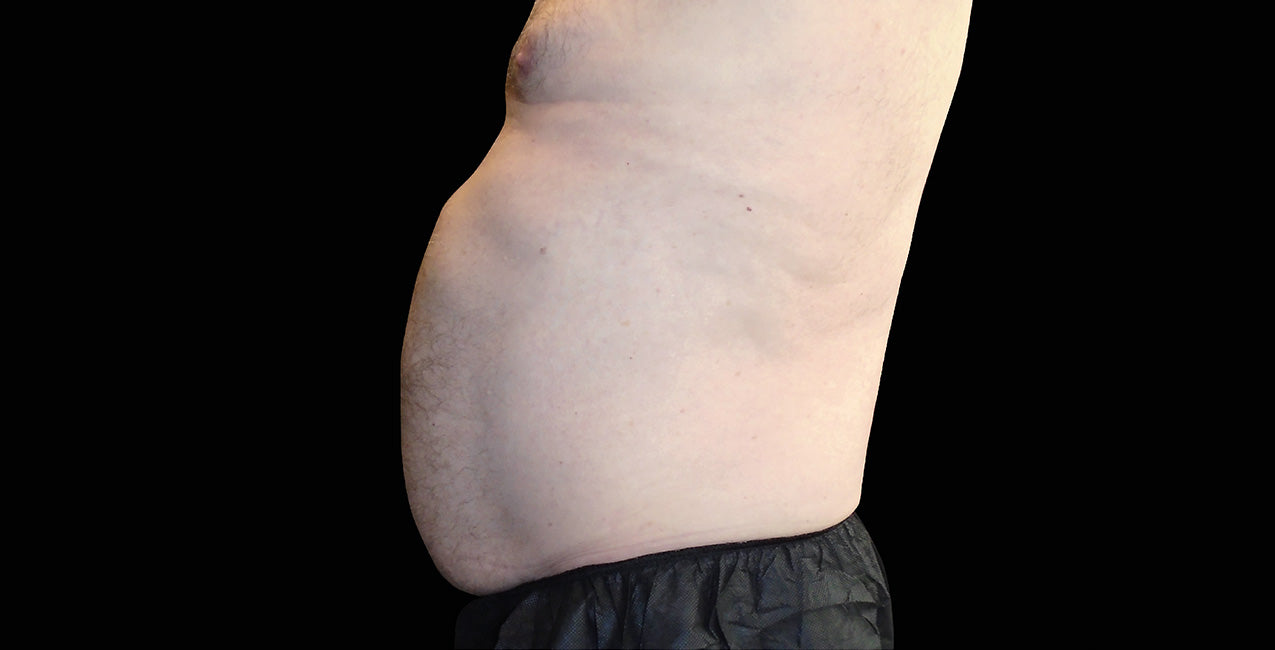 Emsculpt_Neo-Emsella_PIC_Ba-card-male-abdomen-021_ENUS100_before_823584a4-a71e-4e92-890a-68f3e5165d88